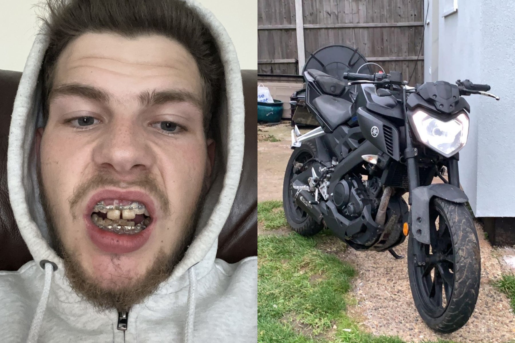 Callum Baldwin, 23, had his jaw wired shut to prevent his face from collapsing after being knocked off his motorbike