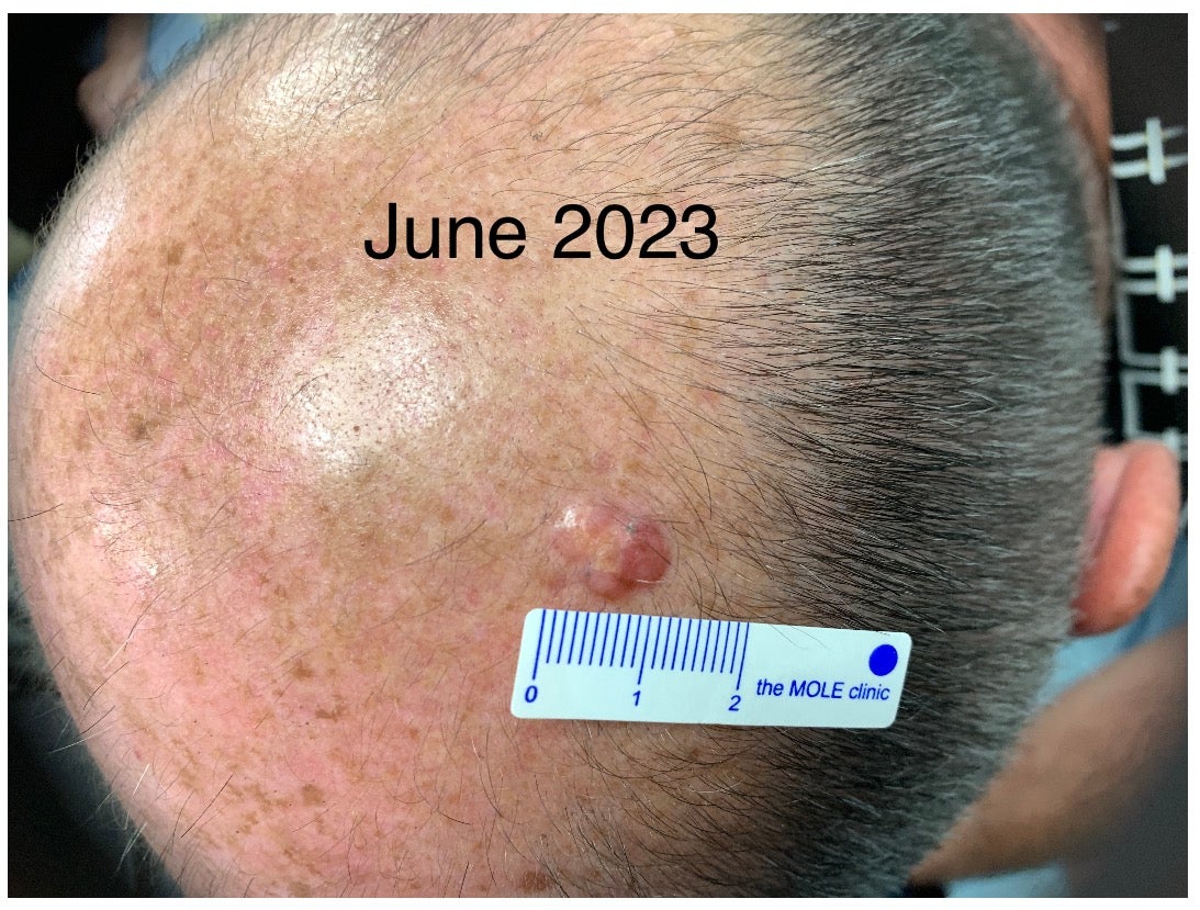 Steve Young, a patient in the clinical trials, showing a melanoma on his head.
