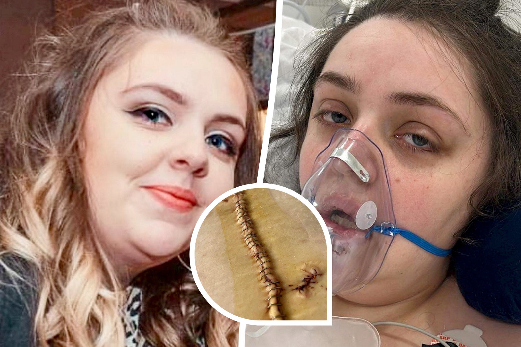 Chloe Quick who was put in a medically induced coma after having surgery for a gastric sleeve in Turkey