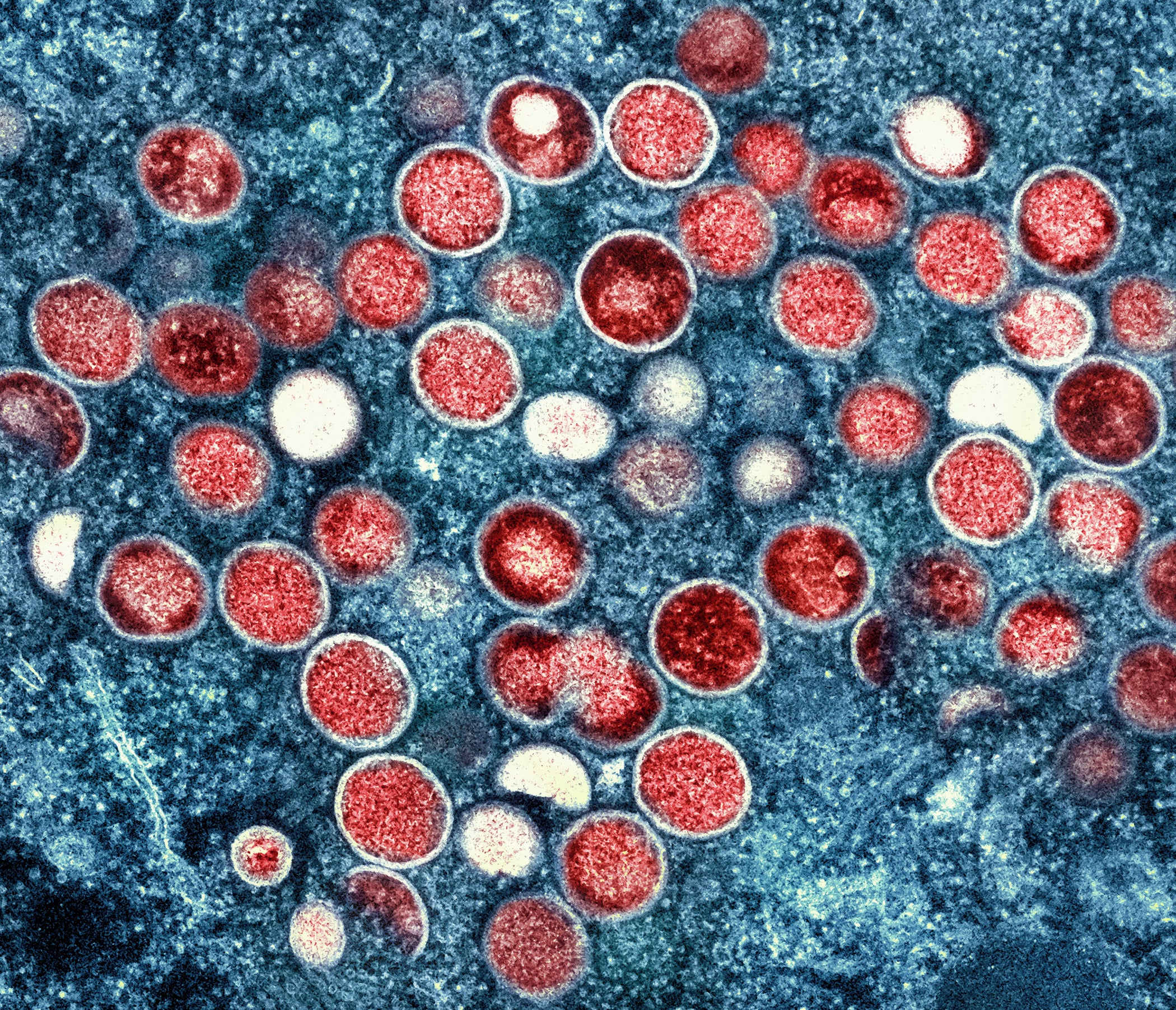 This image provided by the National Institute of Allergy and Infectious Diseases (NIAID) shows a colorized transmission electron micrograph of monkeypox particles (red) found within an infected cell (blue)