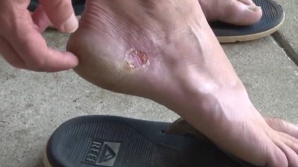 Brent Norman’s feet swelled after coming into contact with the flesh-eating bug