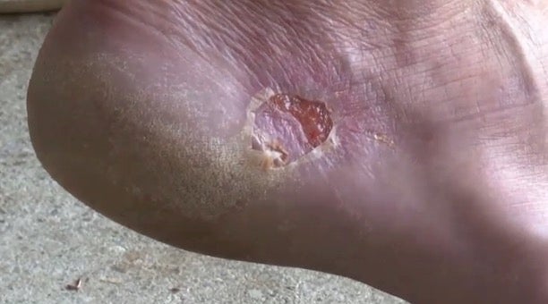 The foot was infected with vibriosis