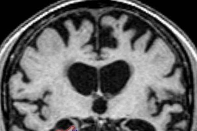 <p>Una resonancia magnética cerebral muestra una atrofia severa indicativa de patología de Alzheimer en las tres áreas, excepto en la corteza perirrinal derecha, que presenta una atrofia moderada</p>