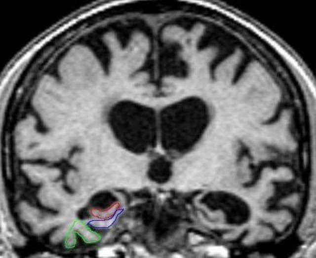 <p>MRI brain shows severe atrophy indicative of Alzheimer’s pathology in all three areas, except the right perirhinal cortex, which has moderate atrophy</p>