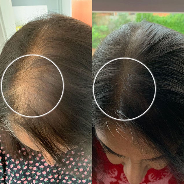 Clinically proven to reduce hair loss with visible results in 90 days