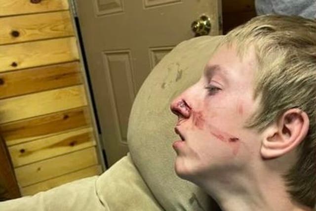 <p>Fifteen-year-old Brigham Hawkins was attacked by a bear while camping with his family last week in Arizona</p>