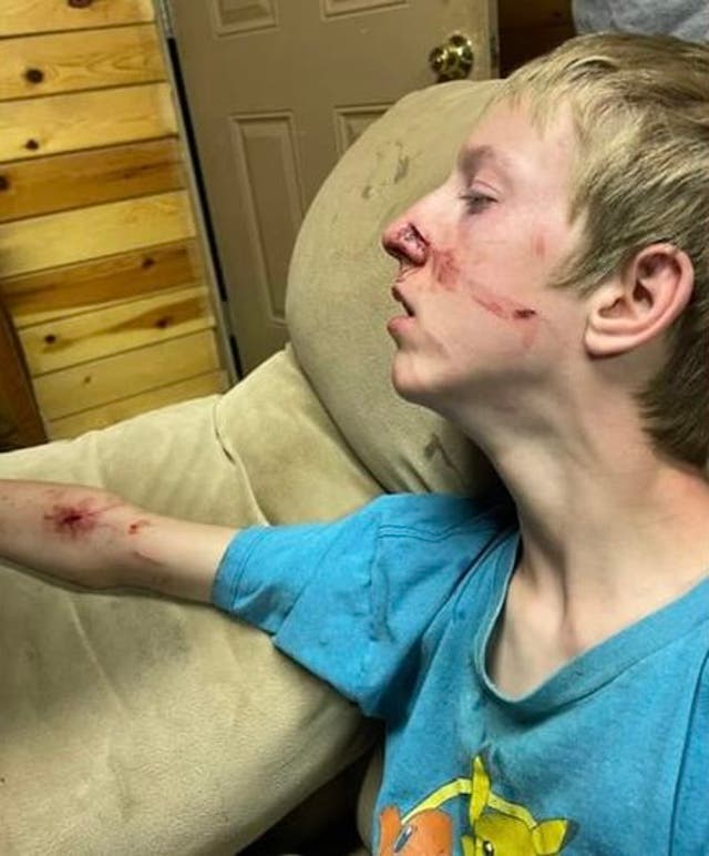 <p>Fifteen-year-old Brigham Hawkins was attacked by a bear while camping with his family last week in Arizona</p>