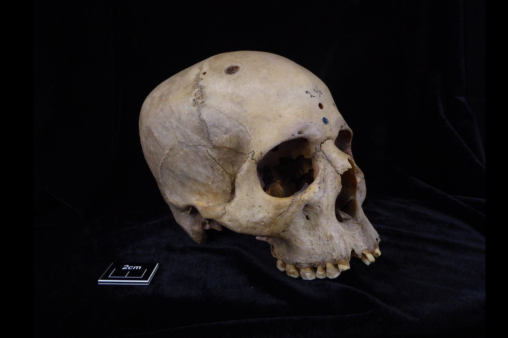 A 4,000-year-old Egyptian skull thought to belong to a male individual aged 30 to 35 (Tondini/Isidro/Camaros/Frontiers in Medicine/PA)