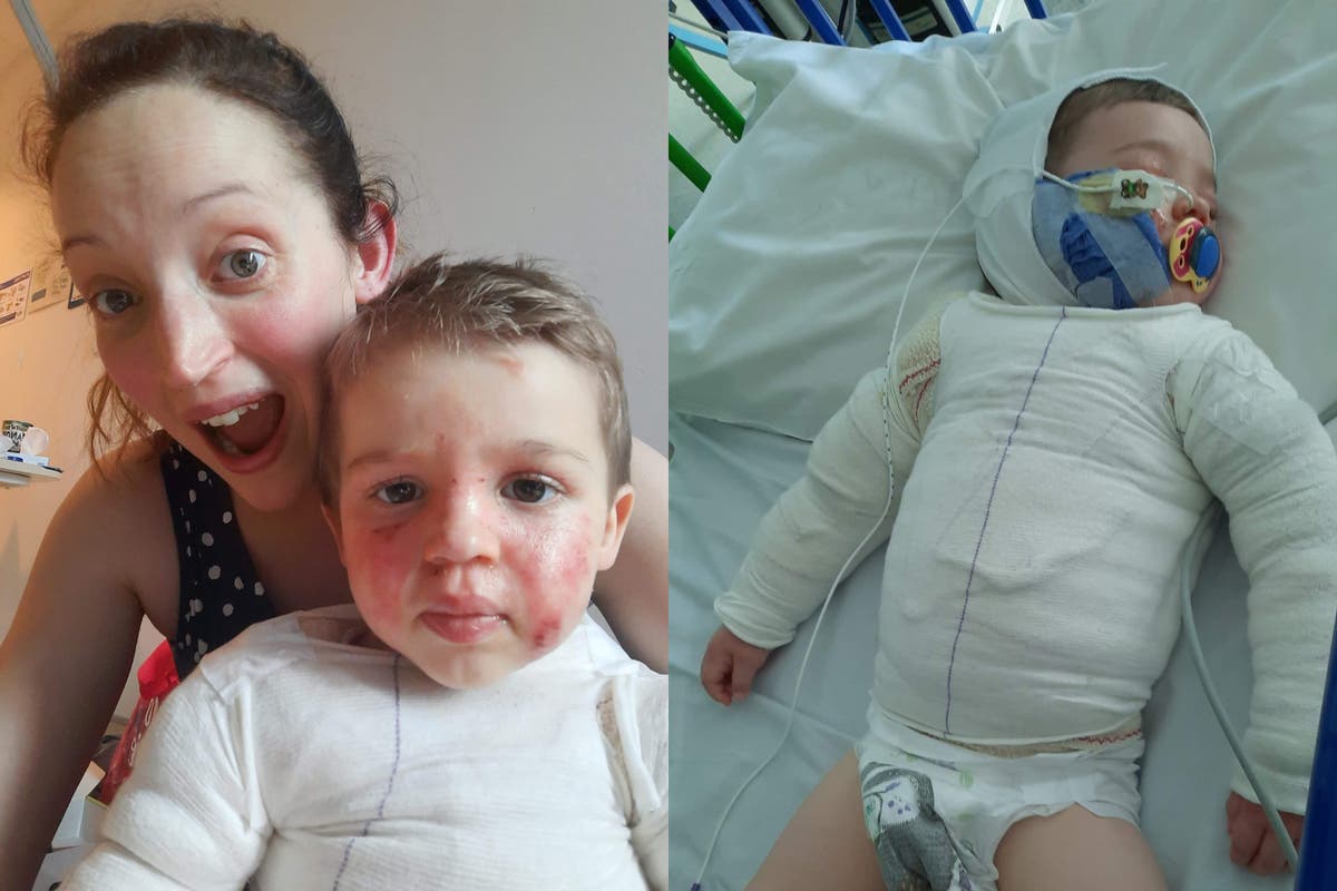 Parents&rsquo; horror after toddler poured boiling tea over himself 