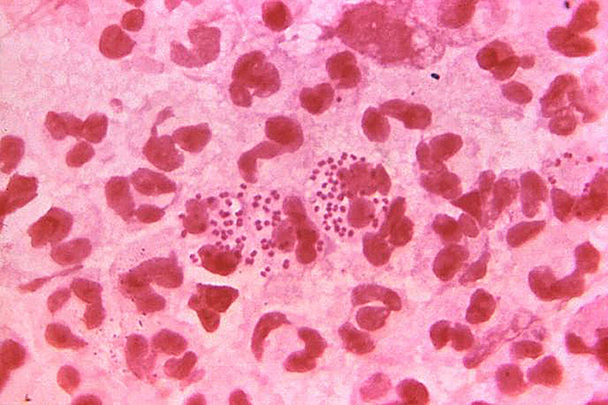 Antibiotic-resistant gonorrhoea cases are on the rise, officials warn