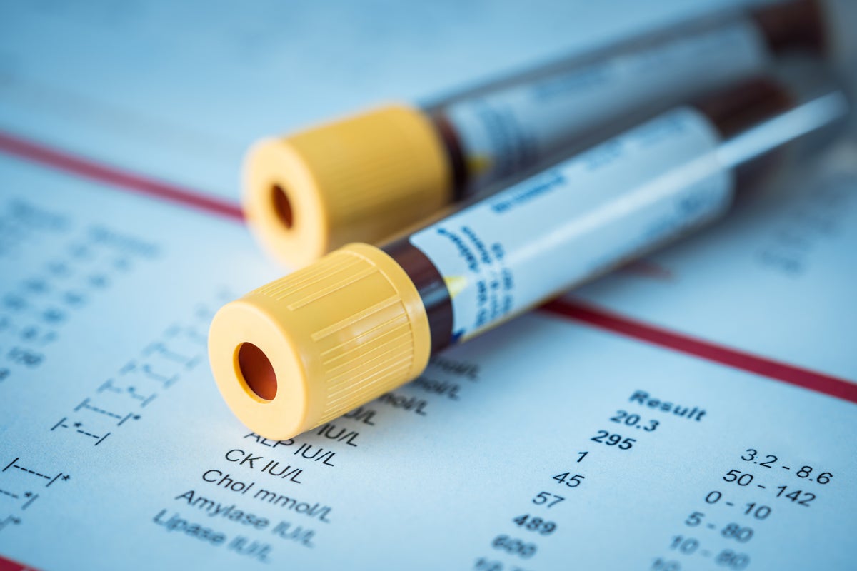 New test for coeliac disease could increase diagnosis rates