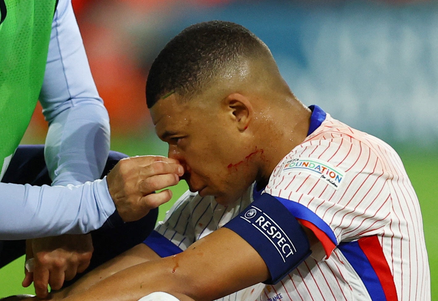 Mbappe suffered a burst nose and was forced off in France’s 1-0 win