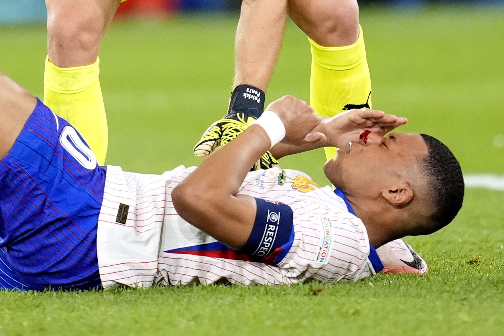 Mbappe broke his nose in France’s opening game