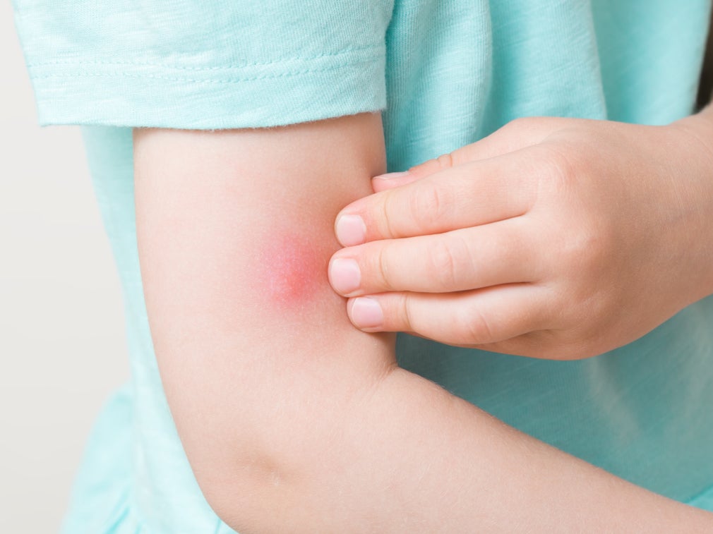 Toddler girl fingers itching red bite of mosquito on arm skin ( Getty Images )