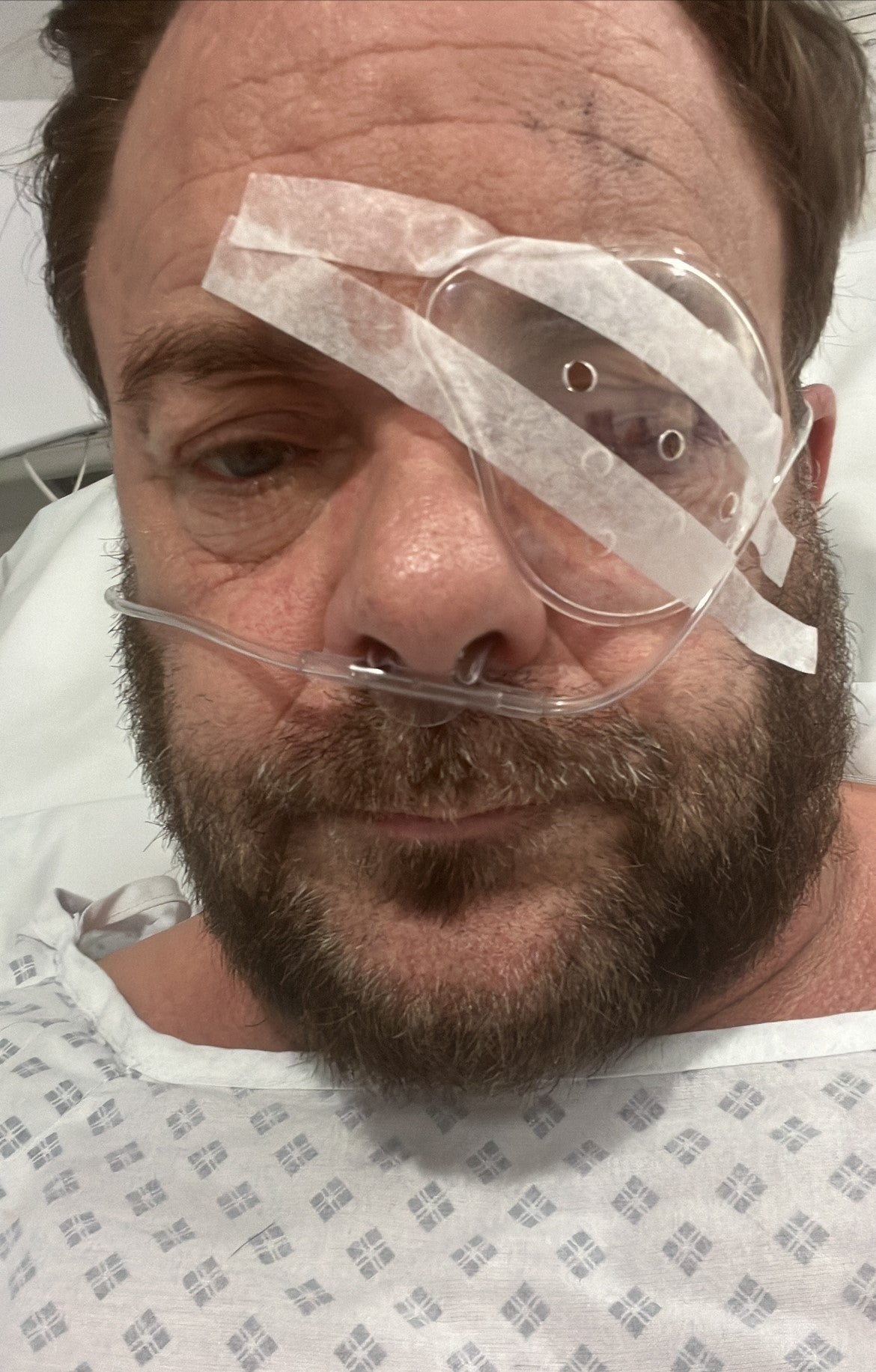Spencer had his left eye “bolted” after the attack in Surbiton