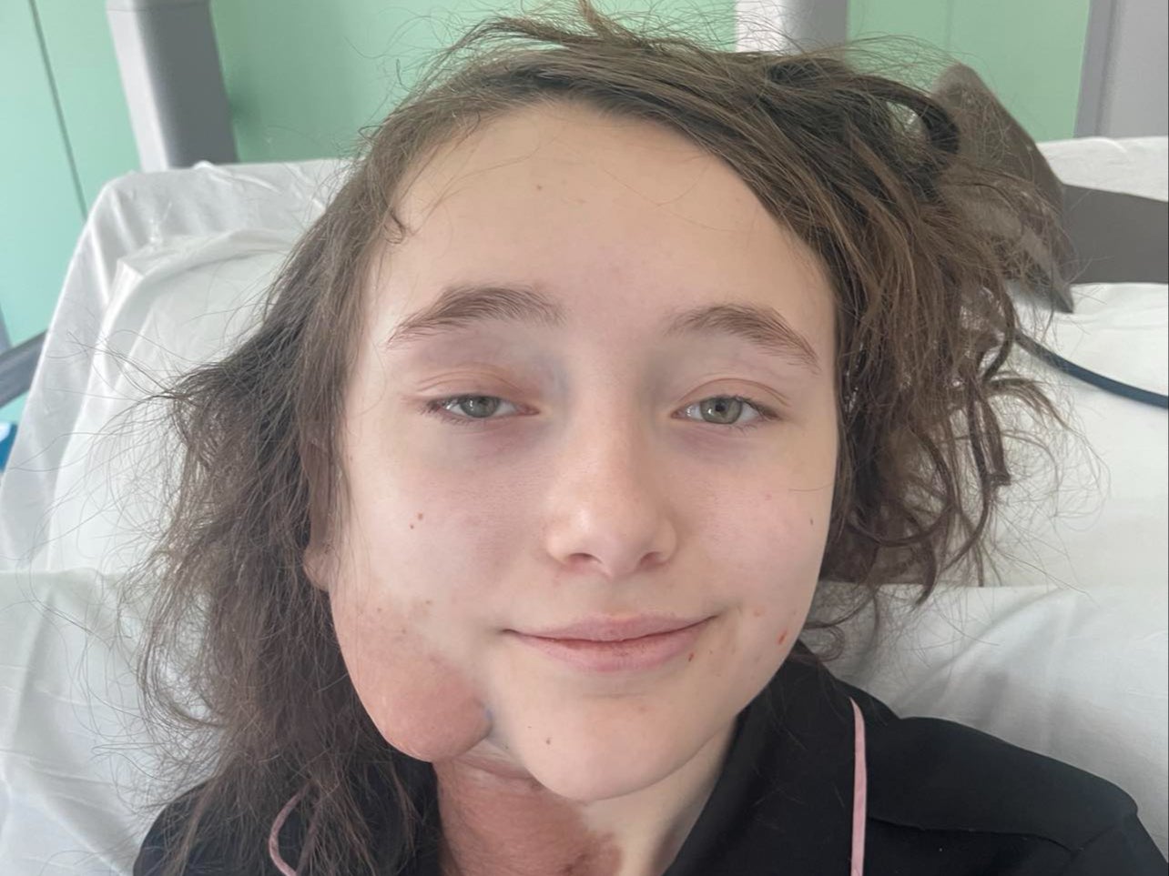Phoebe Weston, 14, in hospital for her first surgery to remove tumours