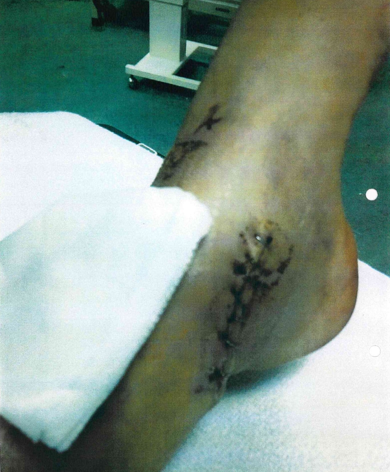 Maria’s ankle bone was shattered into tiny pieces (Collect/PA Real Life) NOTE TO EDITORS: This image must only be used in conjunction with PA Real Life story REAL LIFE MotorbikeCrash. All usage is subject to a fee or incorporated into your outlet’s agreed content package. Find copy in full on PA Explore or contact PA Real Life at RealLife2@pamediagroup.com or on 020 7963 7175 for access or queries