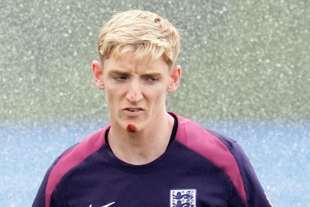 England forward Anthony Gordon is sporting a big cut on his chin after a bike accident