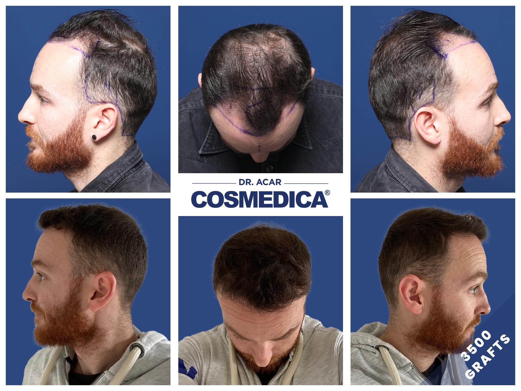 Over the past 16 years, patients have trusted Cosmedica for their hair transplant in Turkey