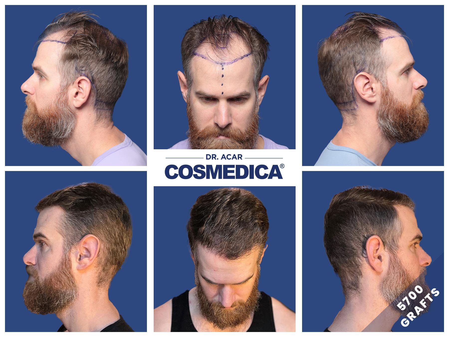 Discover the amazing before-after results of a hair transplant in Turkey at Cosmedica