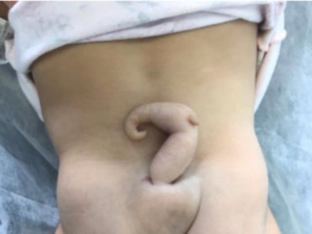 <p>File. An unidentified girl born with tail in Brazil in 2023</p>