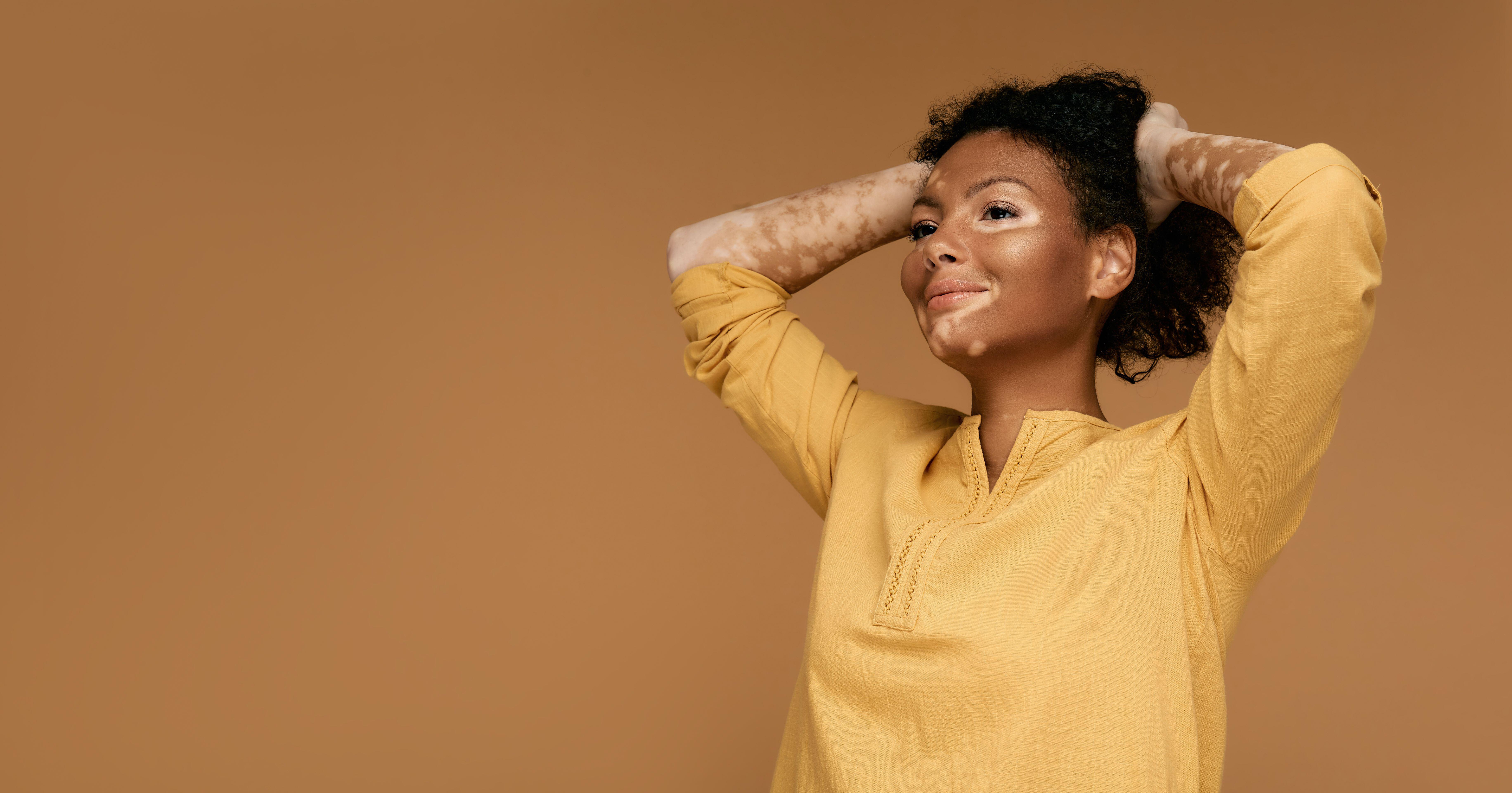 Vitiligo is caused by the lack of melanin (Alamy/PA)