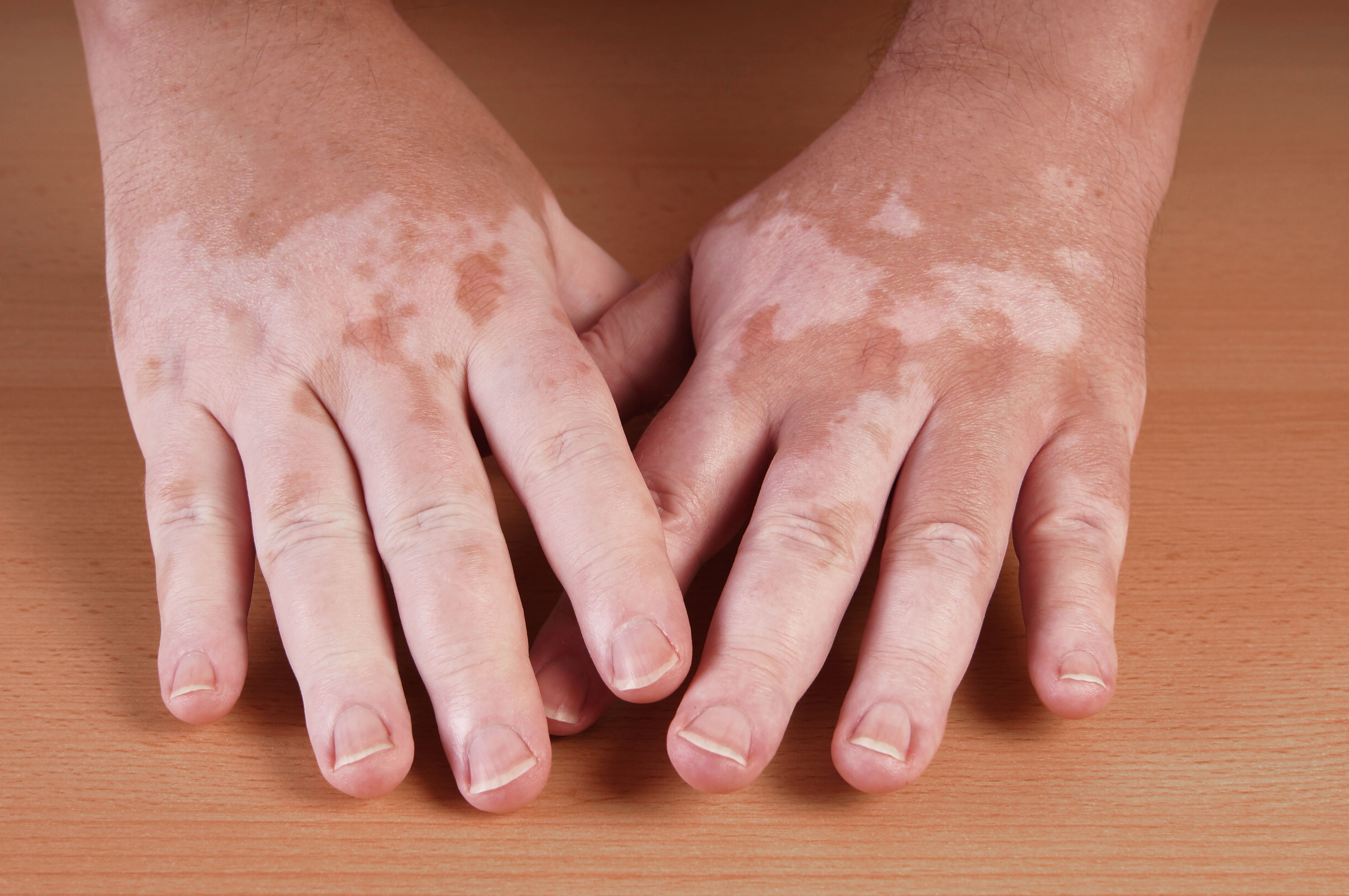 Vitiligo can affect any area of skin, but it commonly happens on the face, neck and hands, and in skin creases (Alamy/PA)