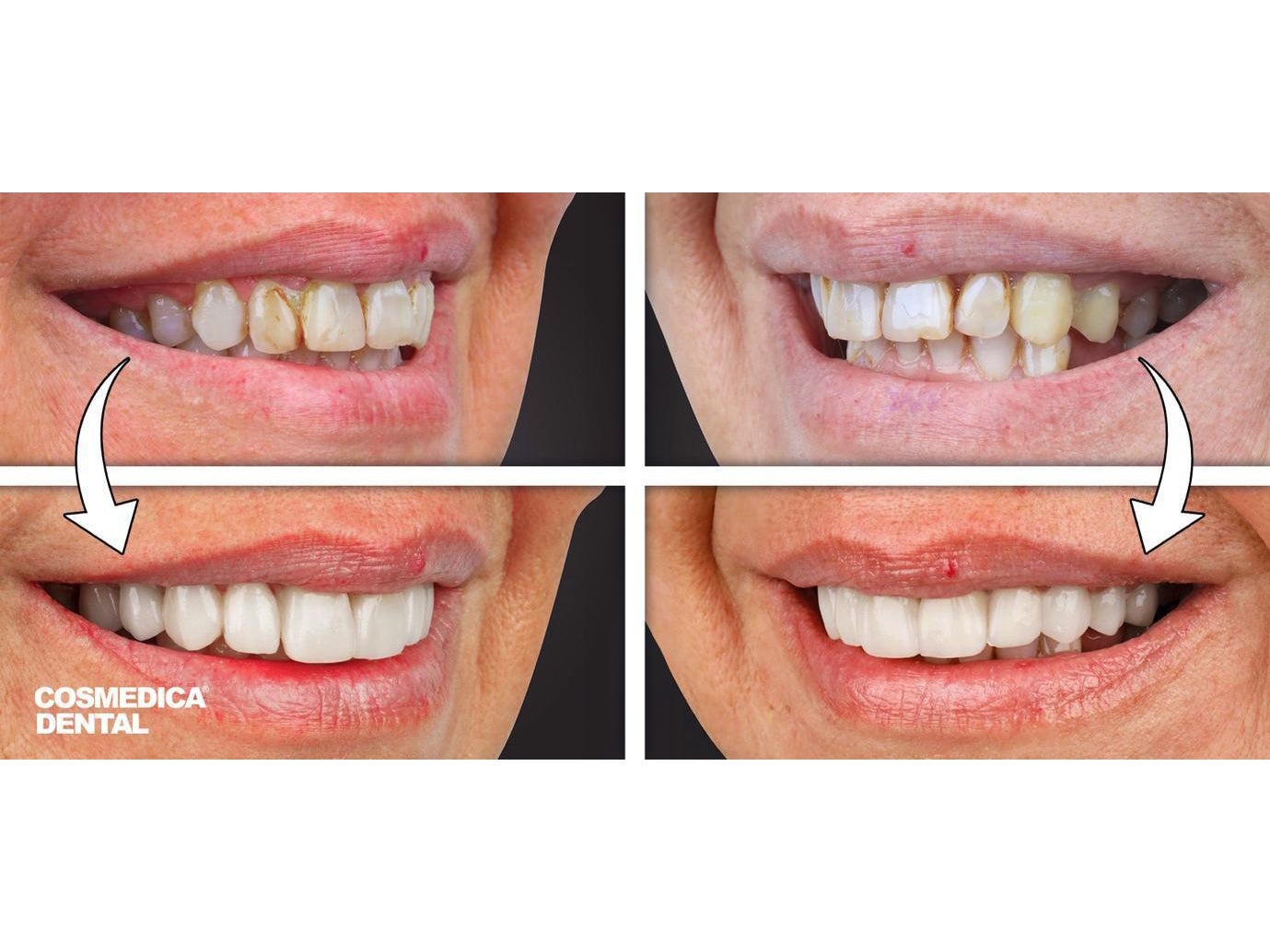 Dental veneers at Cosmedica Dental