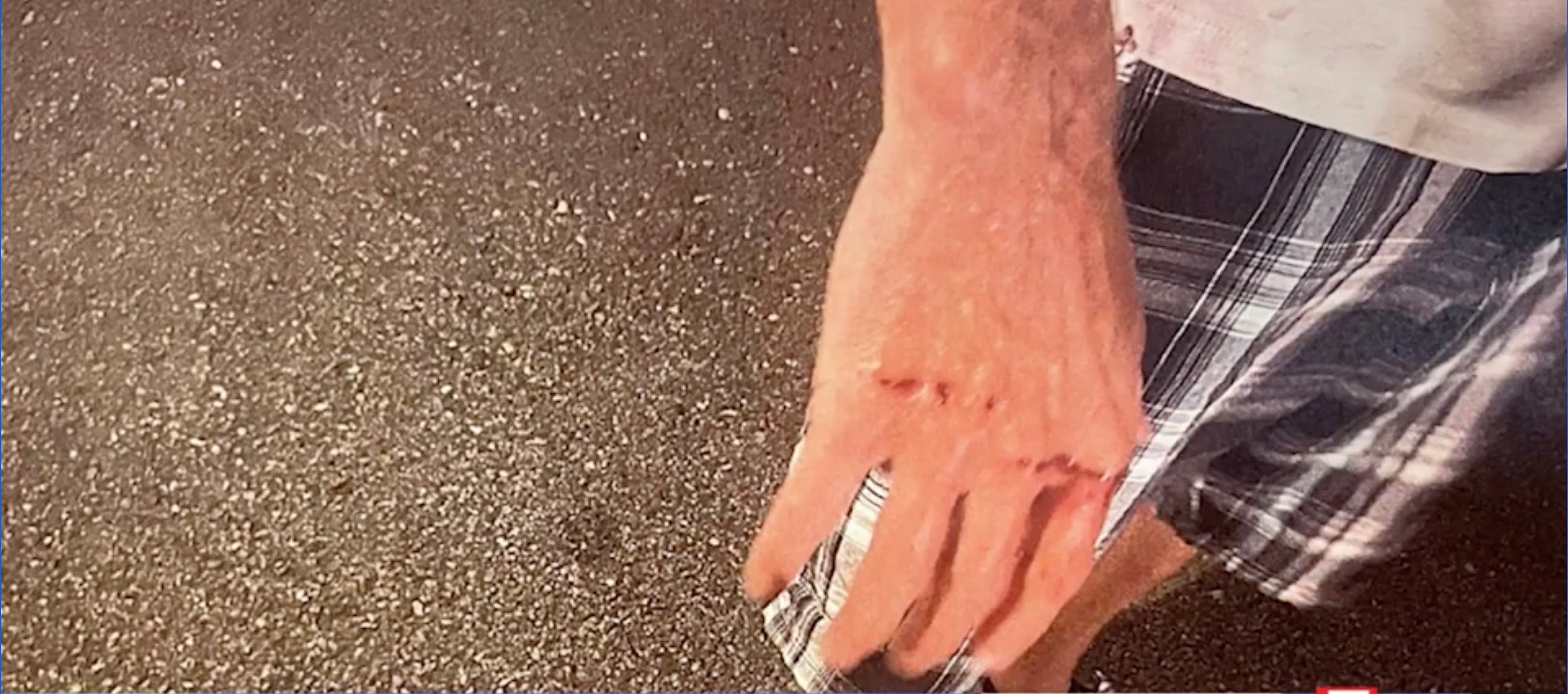 A photo of the injuries Ted O’Connell said he sustained