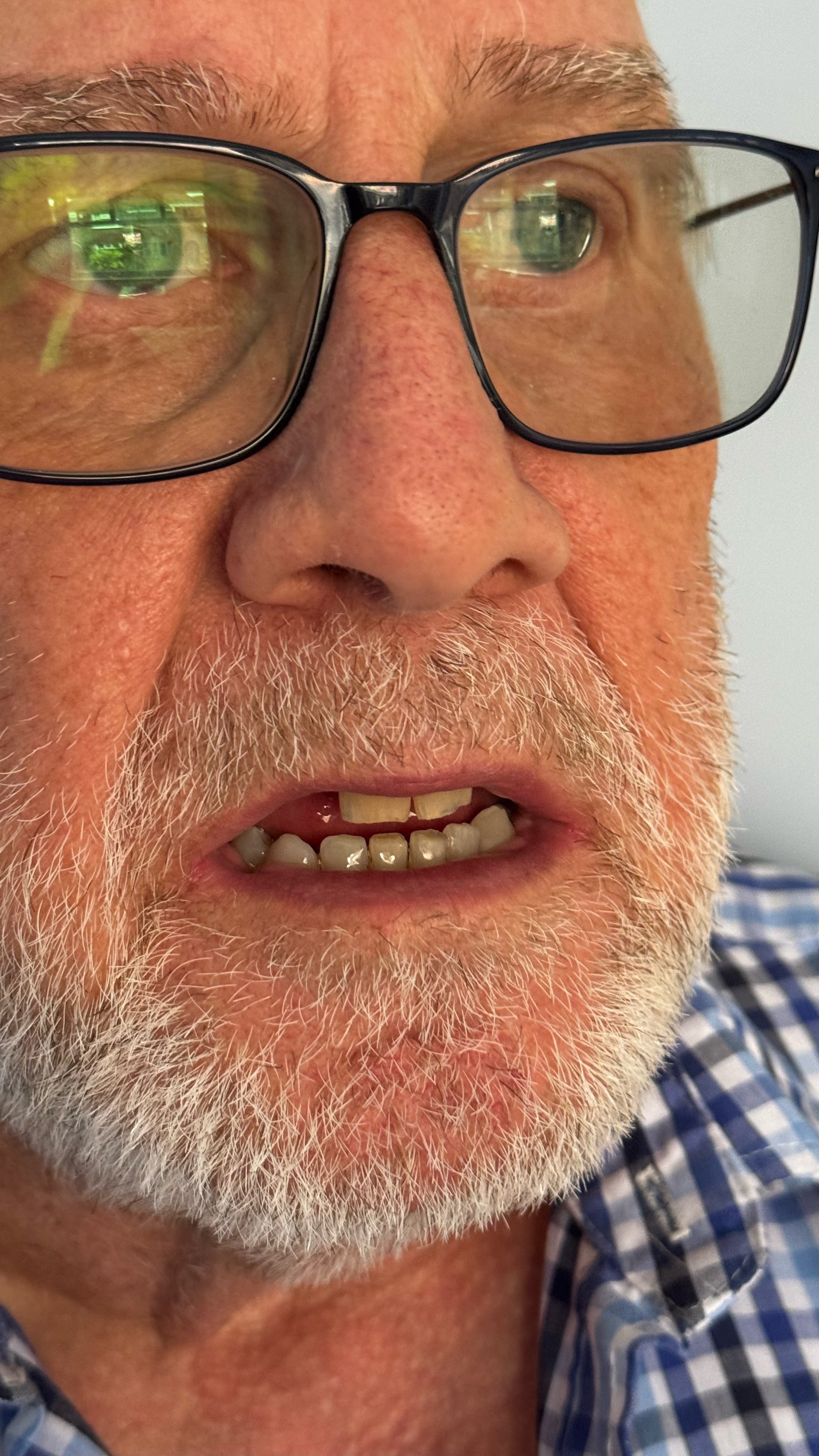 Gerry has been left with a gap in his front teeth