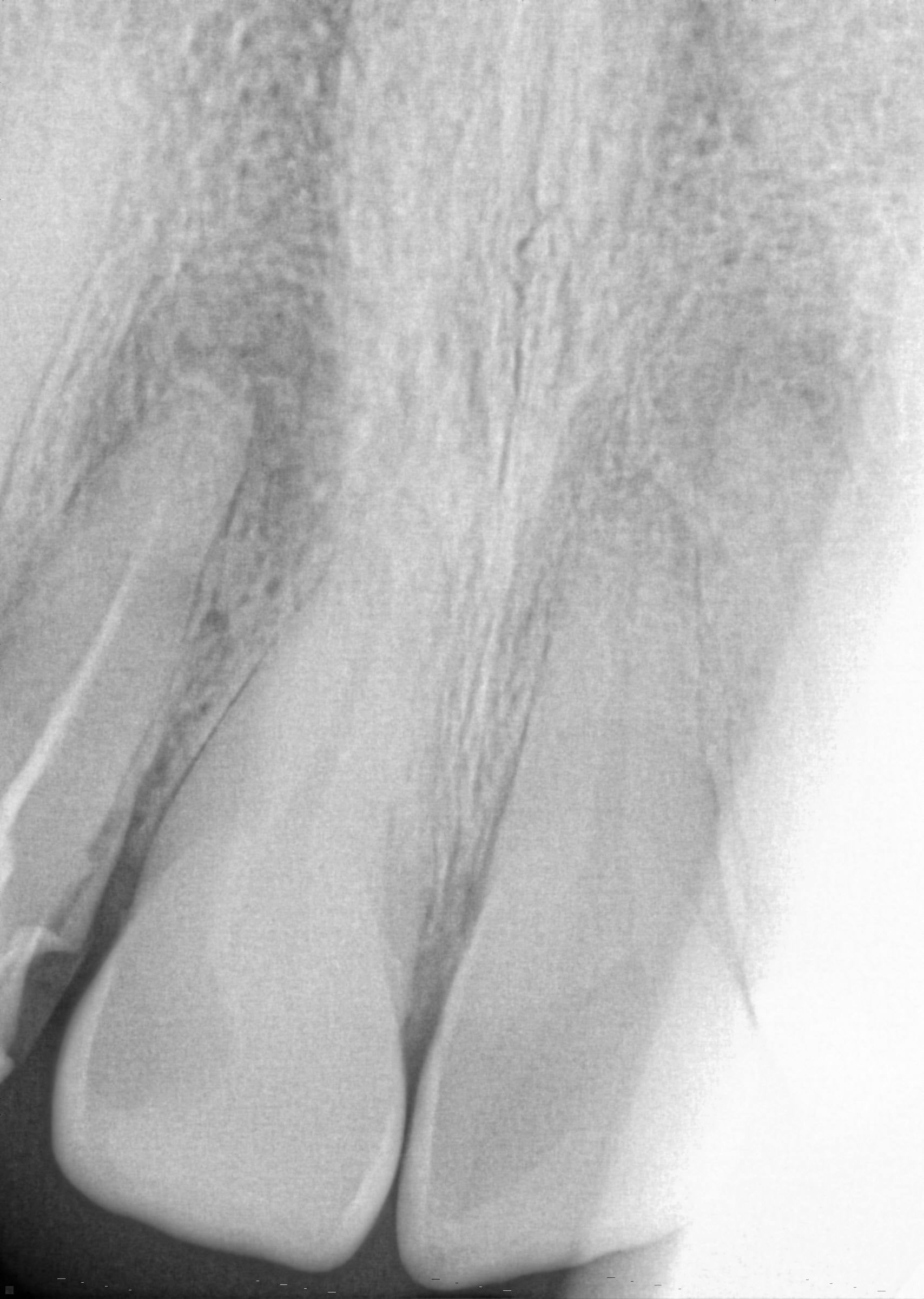 An X-ray showing the defective root treatment