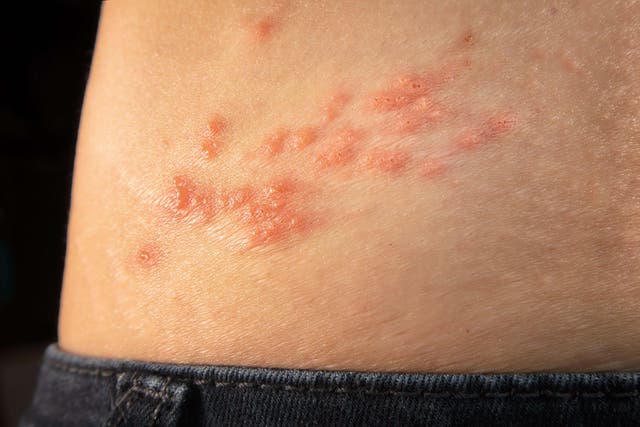 <p>Shingles symptoms include tingling, burning pain, and a distinctive rash</p>