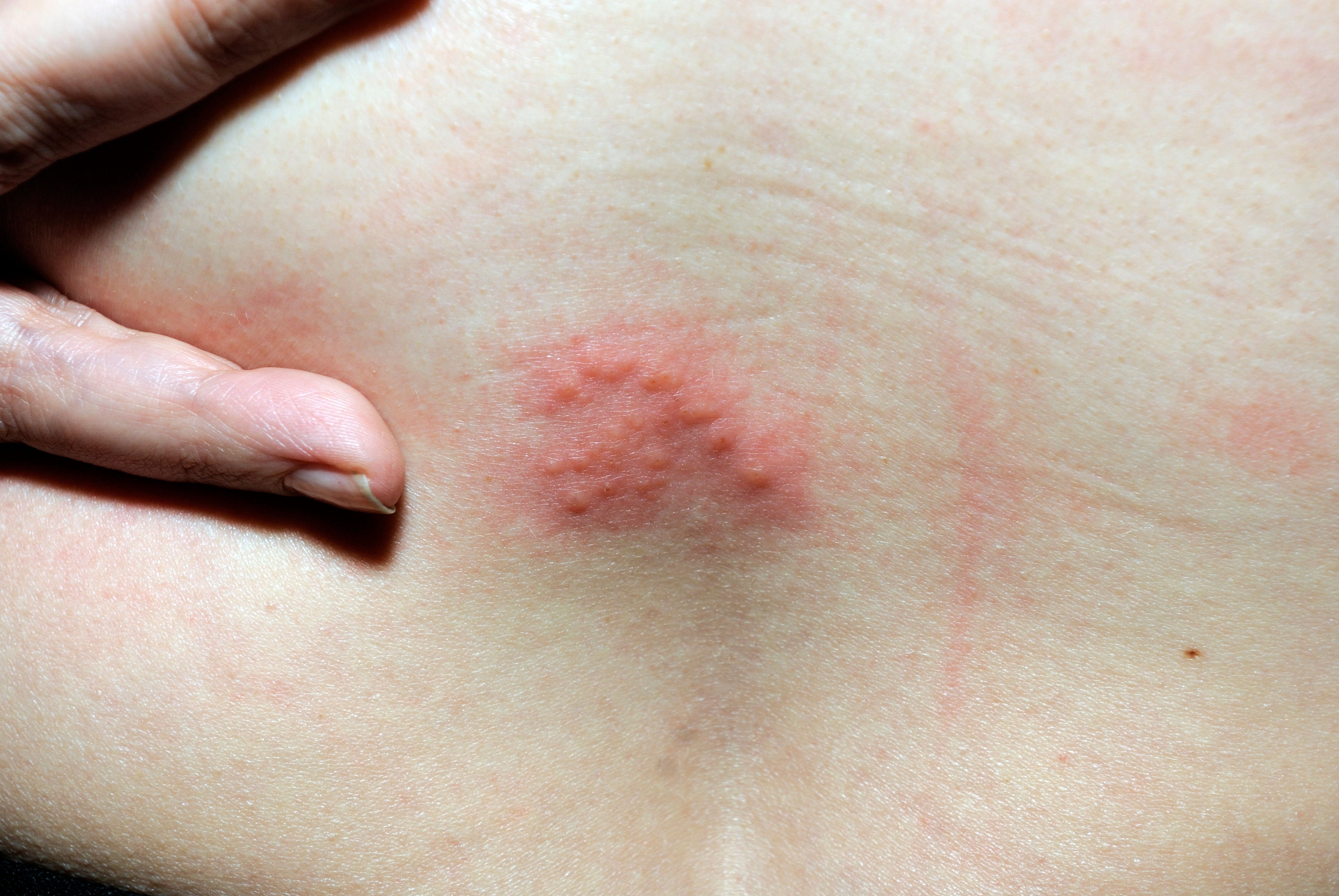 <p>Shingles causes clusters of small, fluid-filled blisters known as vesicles</p>