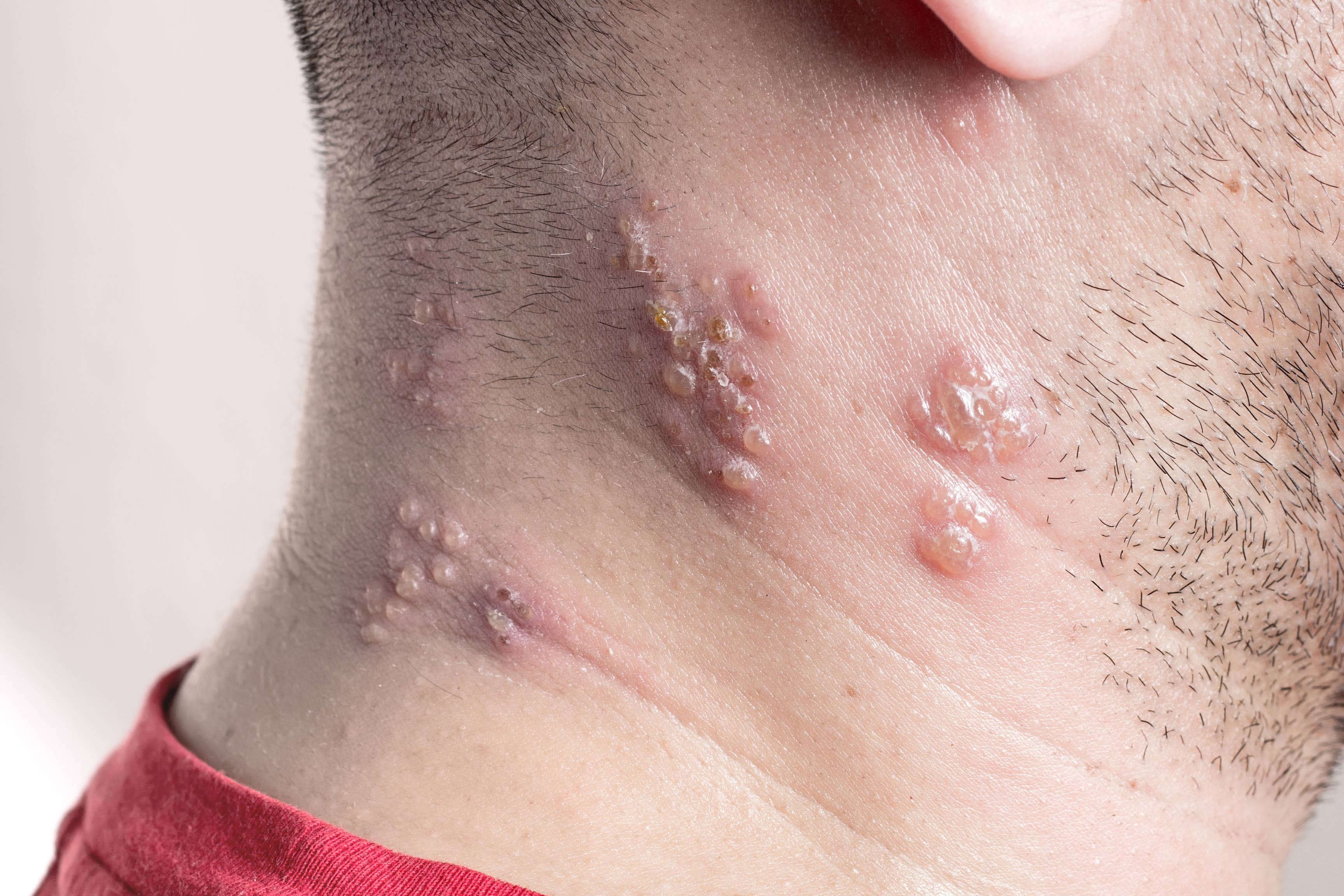 Shingles is caused by the reactivation of the varicella zoster virus (Alamy/PA)