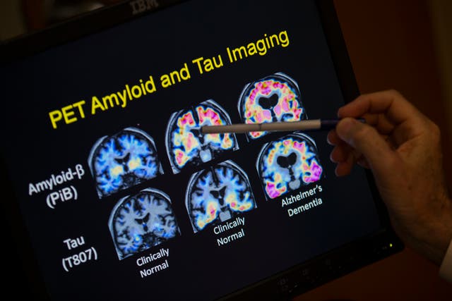 <p> A doctor points to PET scan results that are part of a study on Alzheimer’s disease</p>