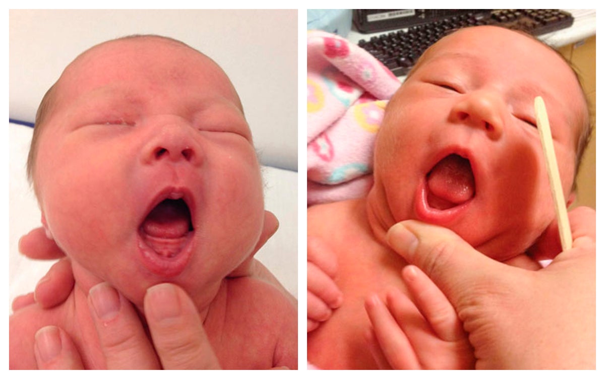 Warning issued over baby tongue-tie operation: ‘It’s almost an epidemic’