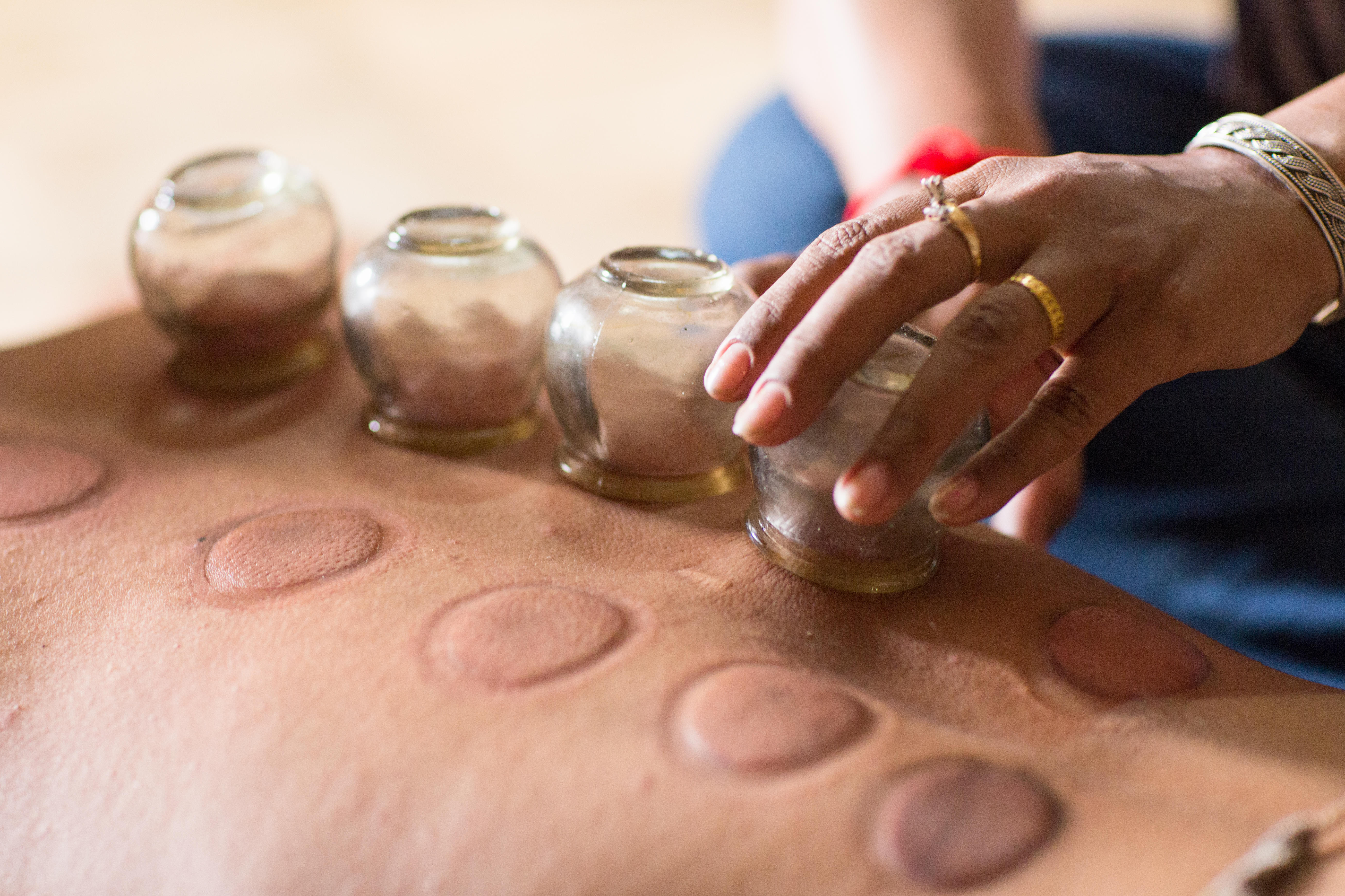 Cupping therapy involves glass or cups (Alamy/PA)