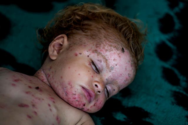 <p>Israel Displaced child Sham al-Hessi, who suffers from skin disease, sleeps at a makeshift tent camp in Deir al-Balah, central Gaza Strip, Monday, July 29, 2024</p>