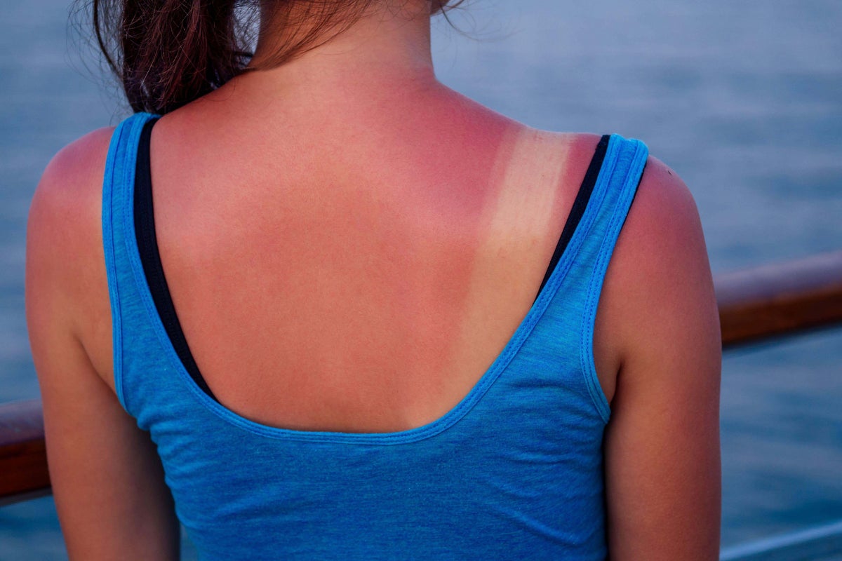 How to soothe painful sunburn