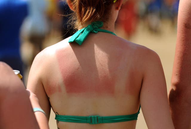 <p>Summer is a hotbed for burn-related injuries</p>