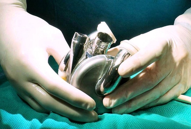 <p>Surgeon holding BiVACOR’s Total Artificial Heart (TAH)</p>