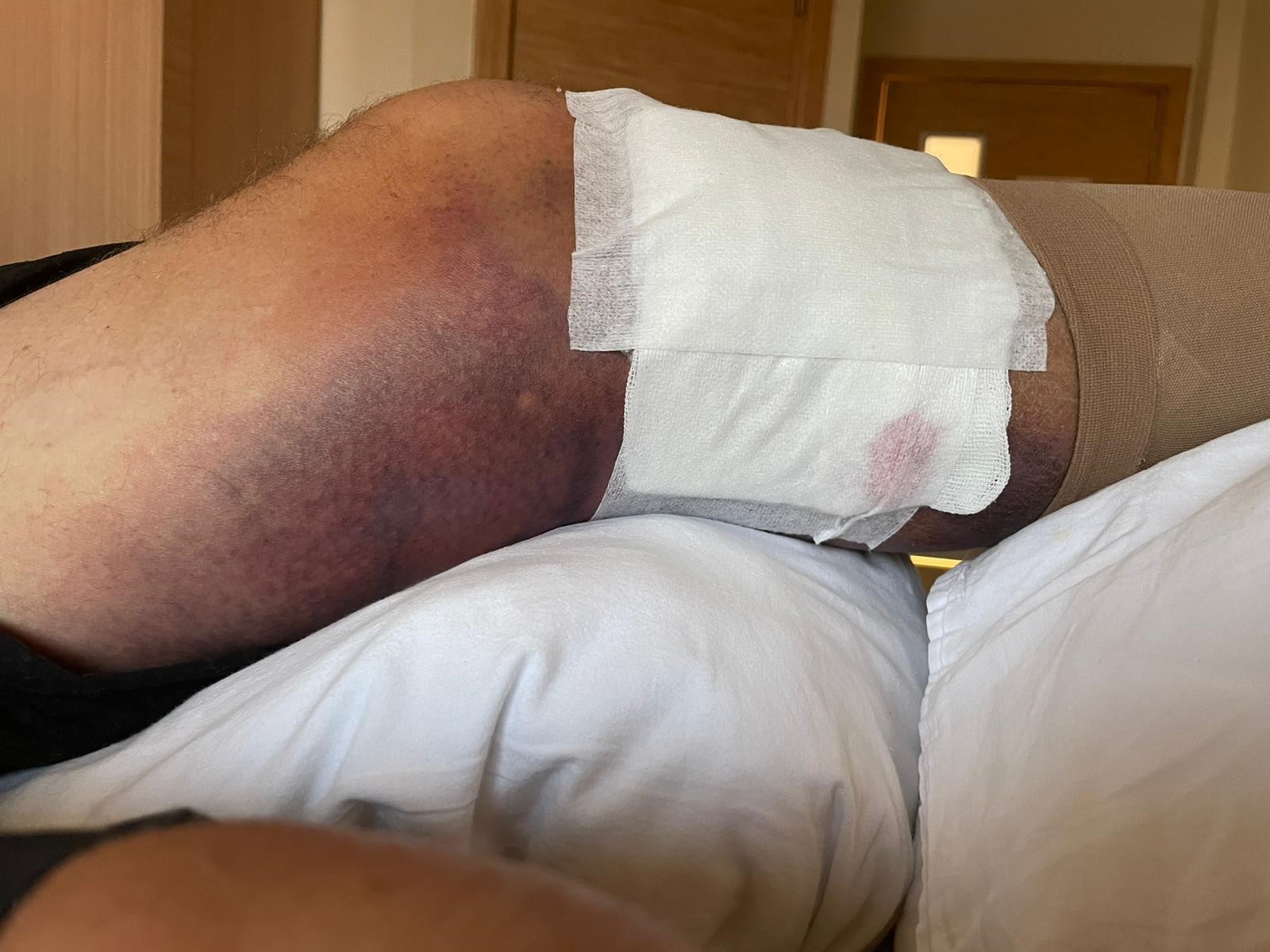 Phillip’s leg started quickly turning black and blue a few days after going swimming in the sea