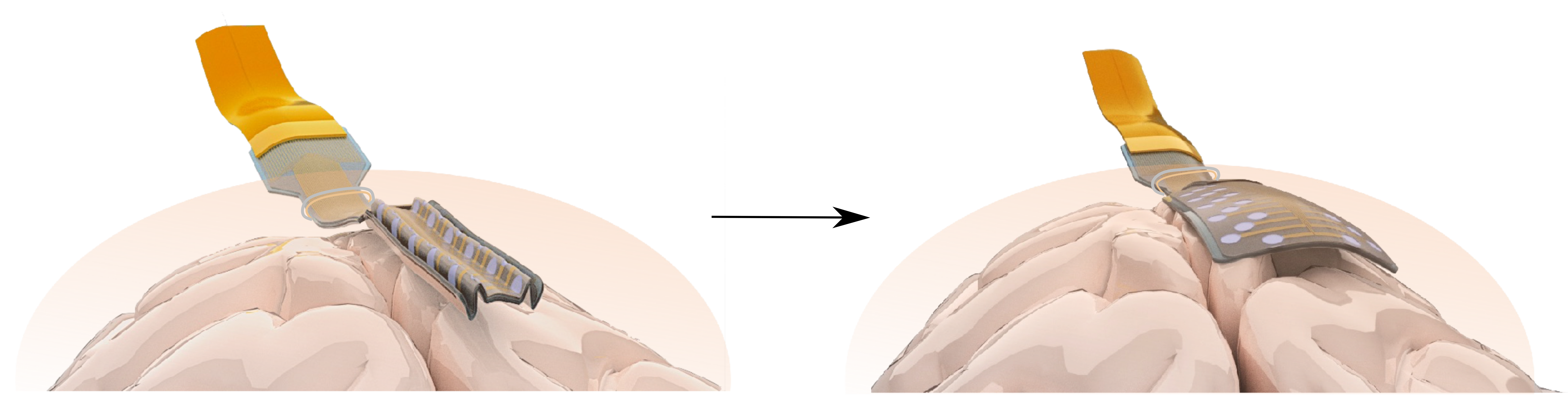 An artist’s impression showing how the electrodes unfold in the brain (Massimo Mariello/University of Oxford)