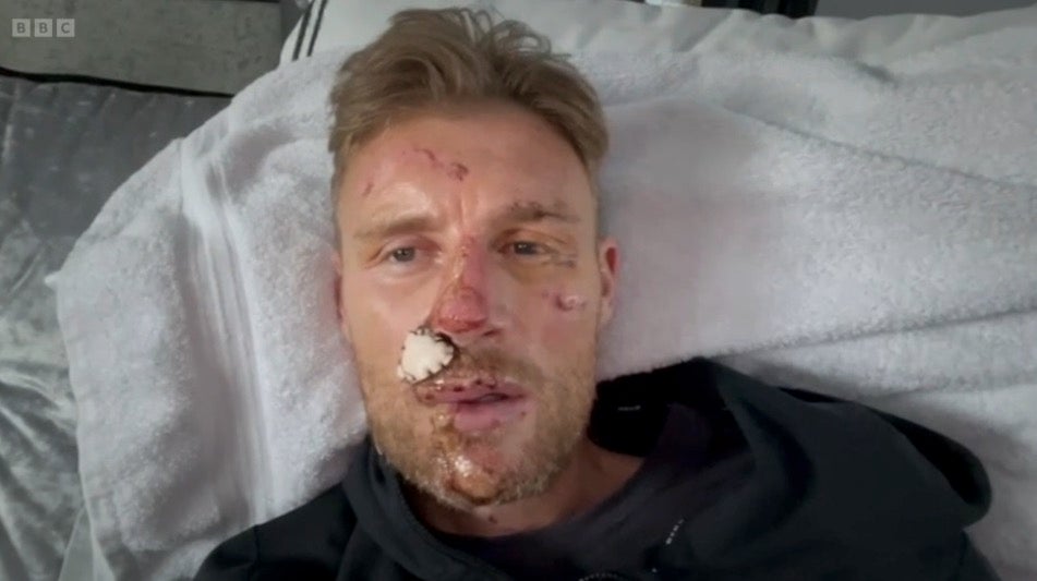 Freddie Flintoff facial injuries from Top Gear crash