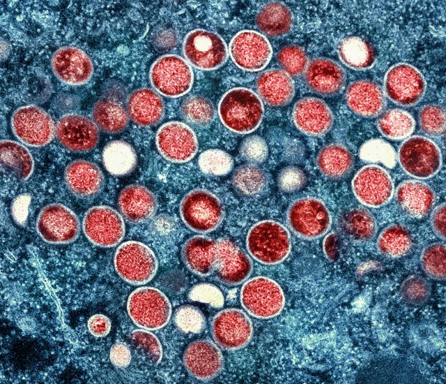 <p>Micrografía de células de la viruela símica </p>