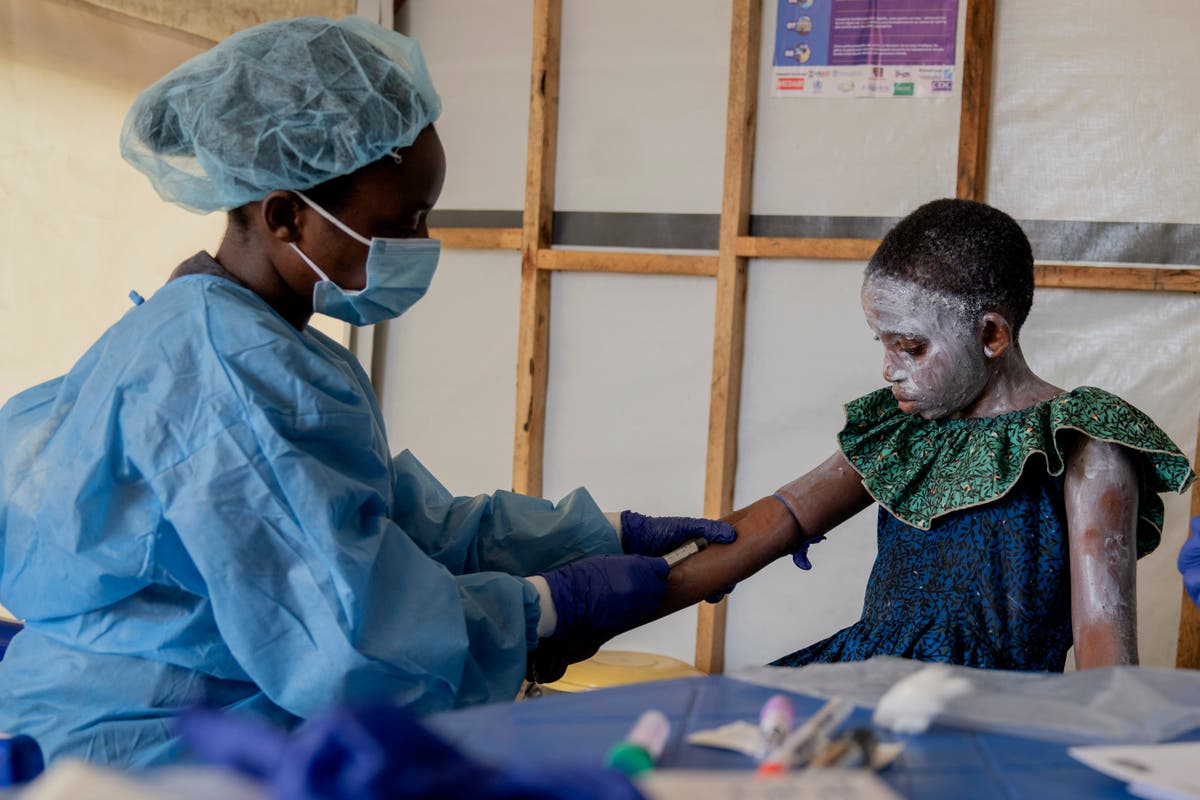 WHO Declares Global Emergency Over Mpox Outbreak