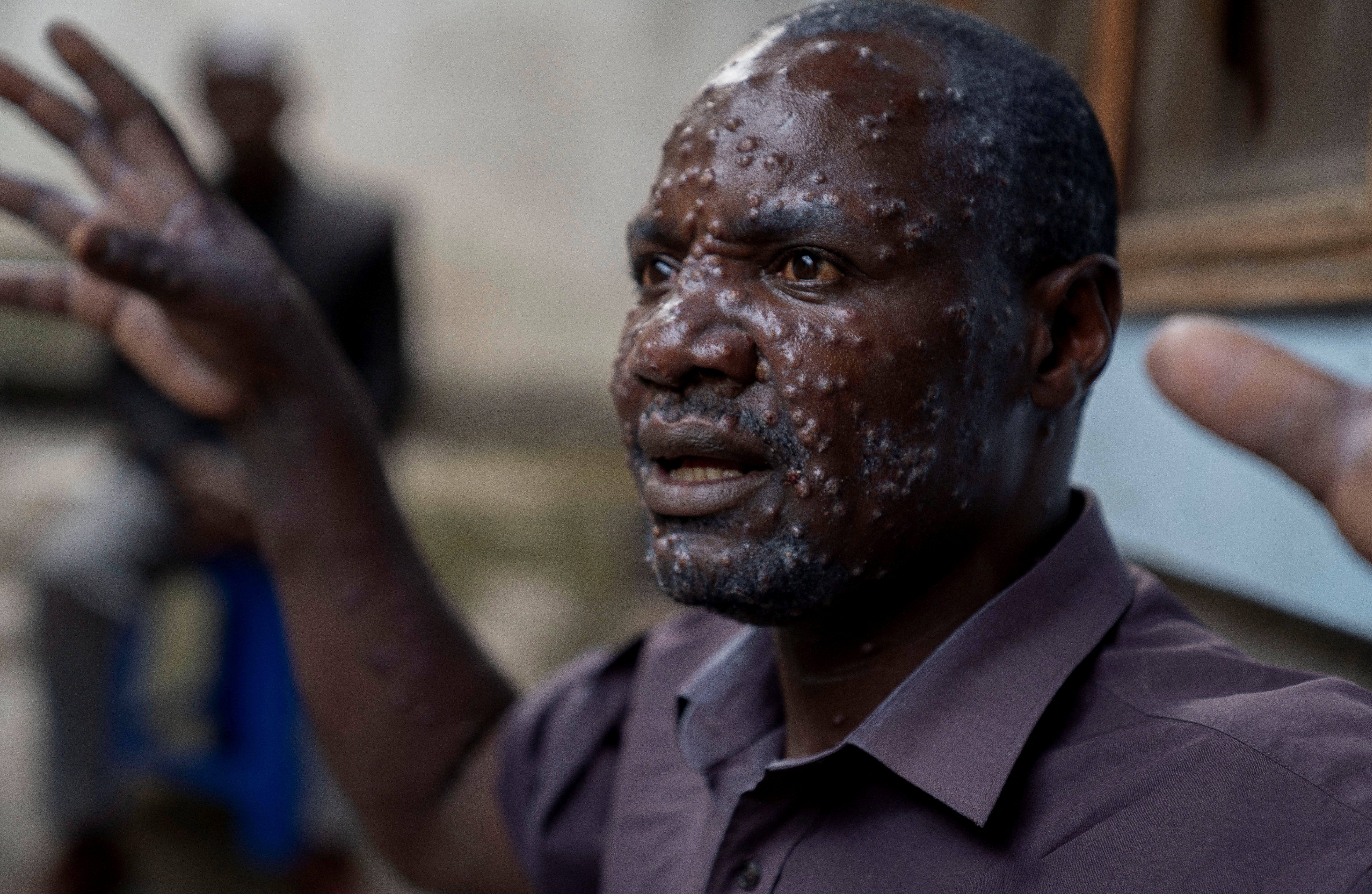 Jean Kakuru Biyambo, 48, a father of six from the Muja internally displaced persons camp, gestures outside his room at the Goma general hospital where he has been receiving treatment against Mpox