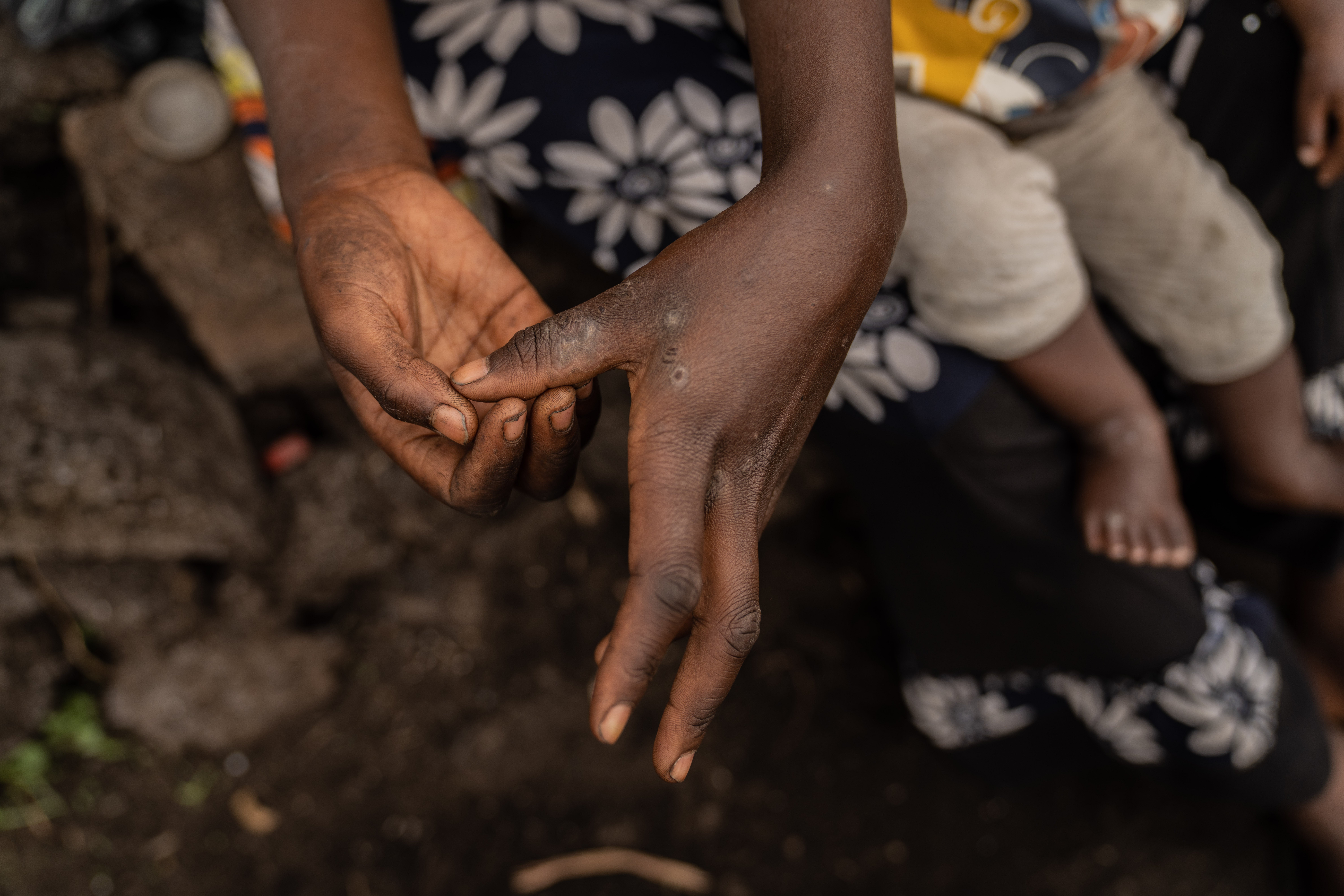 Tuliza Bisere shows her hands as she holds her daughter Ishara who was cured of mpox but still shows scars of the disease in the camp for internal displaced persons in Mudja, Democratic Republic of Congo