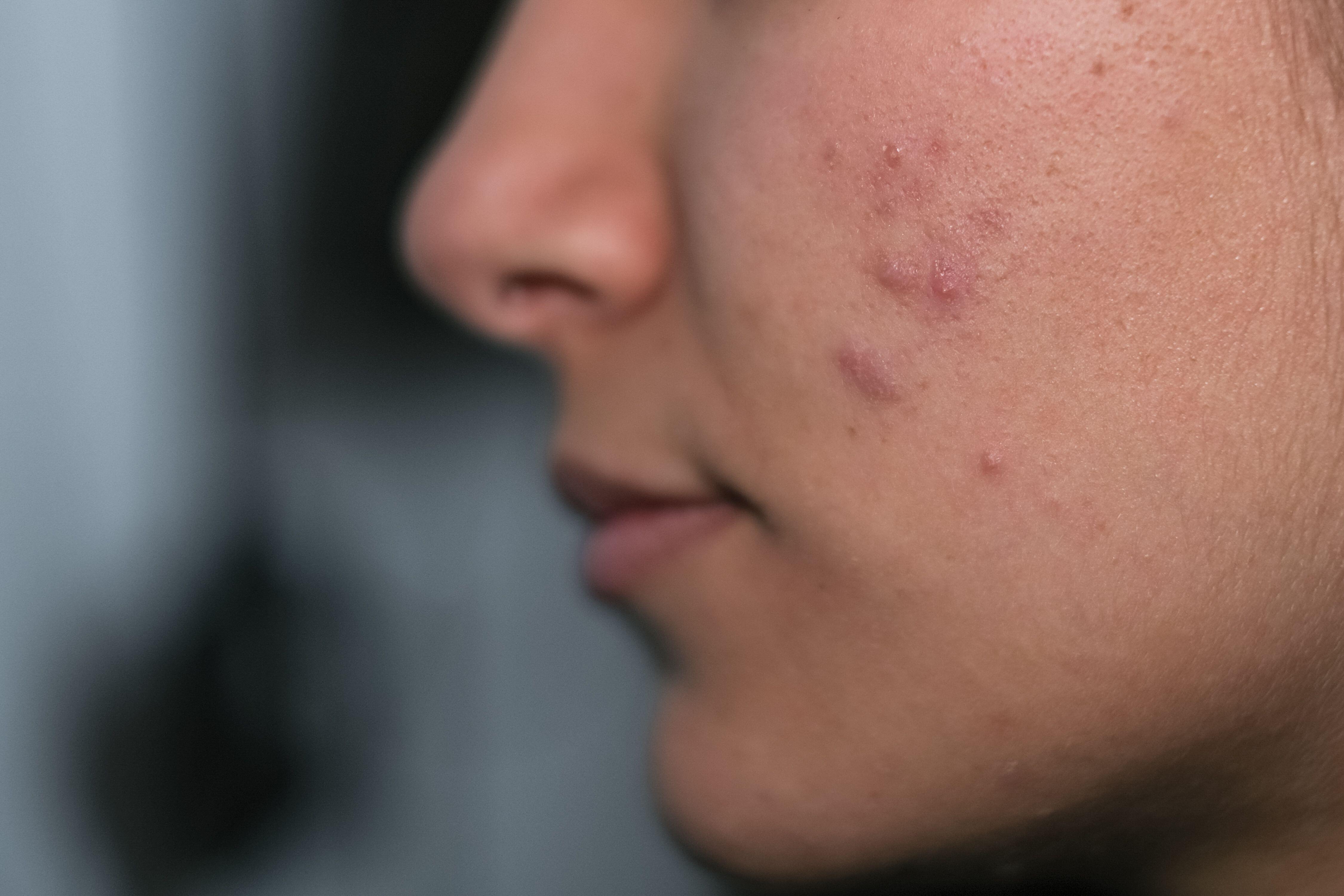 Pcos Skin Rash 6 things everyone needs to know about polycystic ovarian syndrome | The ...