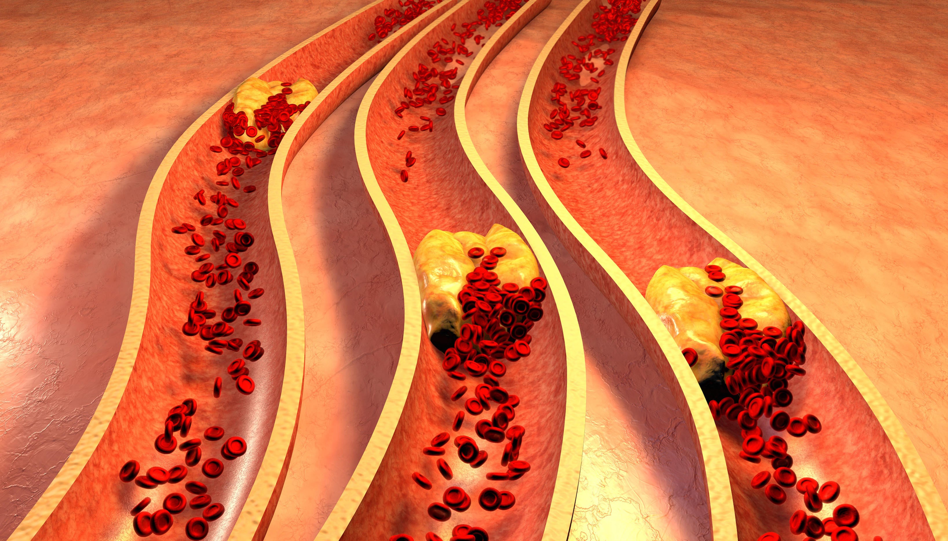 Diagram of a clogged artery with platelets and cholesterol plaque (Alamy/PA)